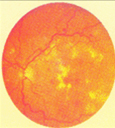 Forms-of-Diabetic-Retinopathy