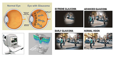glaucoma-eyes-disease